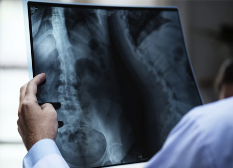 ¿Está en riesgo de caerse por las escaleras?